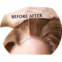 scalp micropigmentation